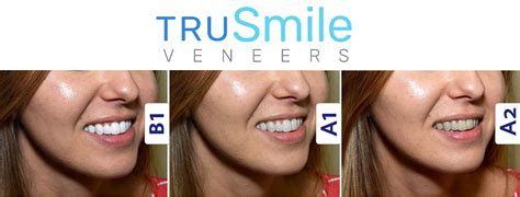 Some come pre-formed, and others are custom-made to fit your teeth. . Trusmile veneers reviews